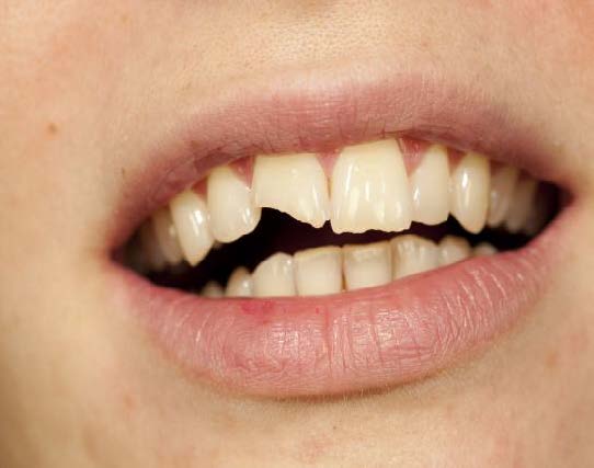 The image shows a close-up of a person s mouth with an open tooth gap, focusing on the teeth and lips.