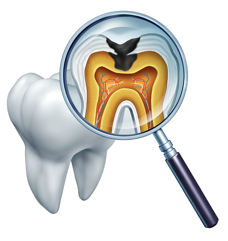 The image shows a magnified view of a human tooth, with an X-ray overlay revealing the internal structure and root canal. A dental magnifying glass is placed in front of the tooth, which has a cavity visible on its surface.