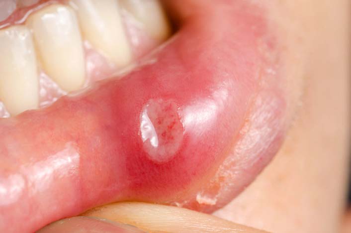 The image shows a close-up of a person s mouth with a noticeable lesion on the lower lip, which appears to be a sore or ulcer.