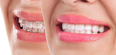 Woman s smiling face with close-up view of teeth and lips, emphasizing oral health or beauty.