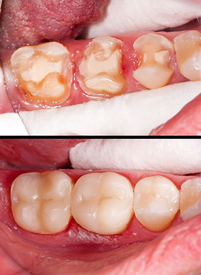 The image shows a close-up of a person s teeth with visible signs of decay and discoloration, highlighting the need for dental care or treatment.