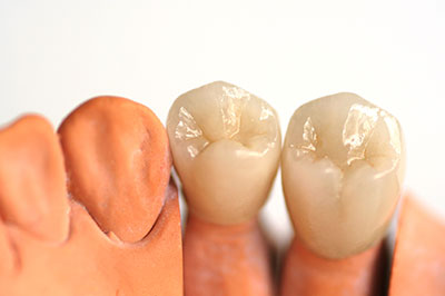 An image of a set of dental implants with a focus on the lower jaw, showcasing their naturalistic appearance and placement.