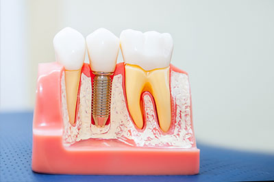 The image shows a model of a human mouth with artificial teeth and gums, featuring dental implants, screws, and a metal fixture.