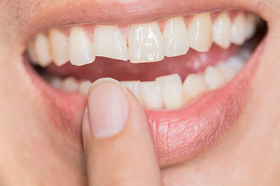 The image shows a close-up of a person s mouth with teeth, holding a finger in front of their teeth.