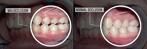 The image shows a side-by-side comparison of two sets of teeth, with one set appearing to be in the process of being repaired or restored, as indicated by the presence of a dental implant and the use of the term  malocclusion  in the context of the second set.