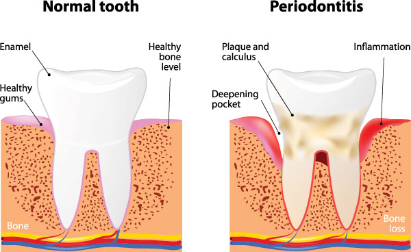 The image is a medical illustration showing the stages of tooth decay, from normal to severe, with annotations indicating the progression and potential complications such as periodontitis.
