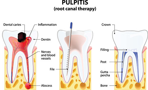 The image is an educational diagram illustrating the process of pulpitis, showing a root canal therapy with labeled parts such as dental caries, inflammation, crown, and tooth structure.