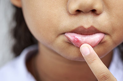 A young child with a noticeable skin condition, pointing at it with their finger.