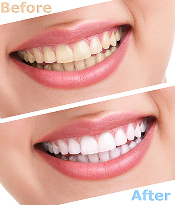 The image displays a side-by-side comparison of a person s teeth before and after a dental treatment, showcasing the transformation from stained to clean and white teeth.