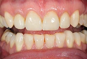 The image shows a close-up of a person s mouth with teeth that appear to be in need of dental care.