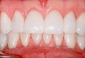 The image shows a close-up of a person s teeth, emphasizing the brightness and cleanliness of the smile.