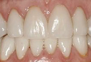The image shows a close-up of a person s teeth, featuring a wide smile with white teeth and some visible wear or staining.