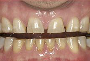 A close-up of a person s teeth with yellowing and discoloration, showcasing dental wear and staining.